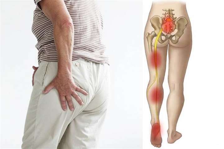 علاج ألم عرق النسا بدون جراحة